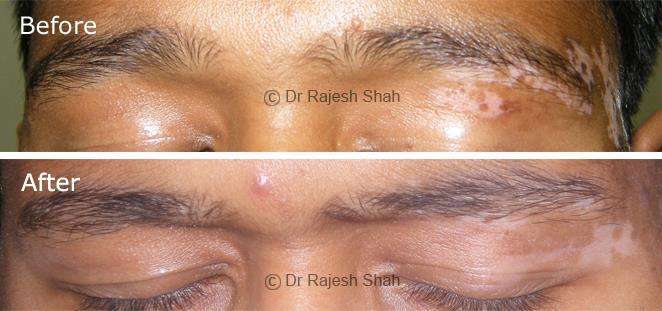 Vitiligo Before and After Case Photo