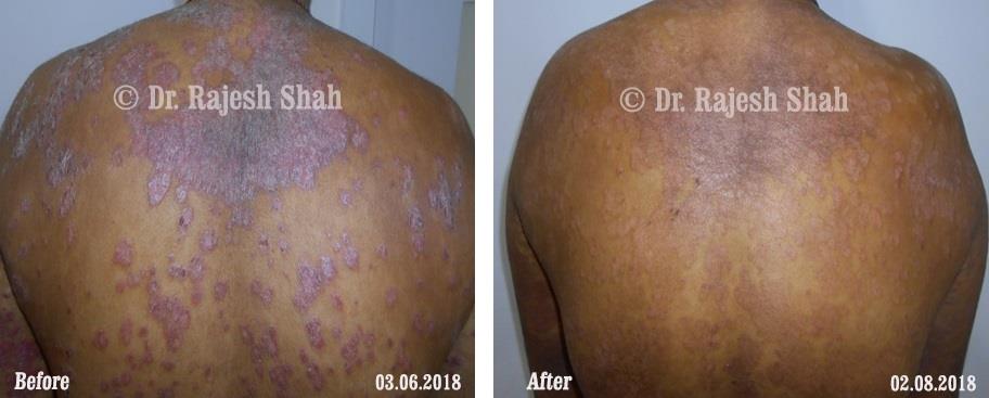 Psoriasis Before and After Case Photo