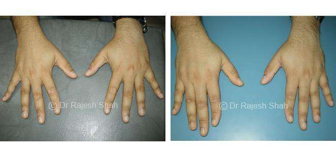 Vitiligo Before and After Case Photo