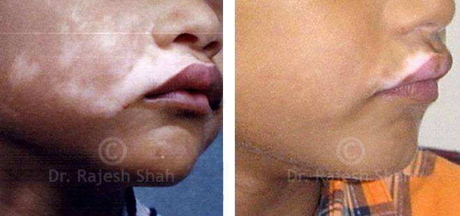 Vitiligo Before and After Case Photo