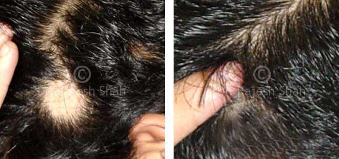 Alopecia Areata Before and After Case Photo