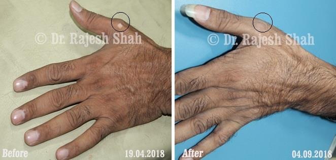 Vitiligo Before and After Case Photo