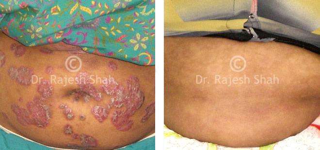 Psoriasis Before and After Case Photo