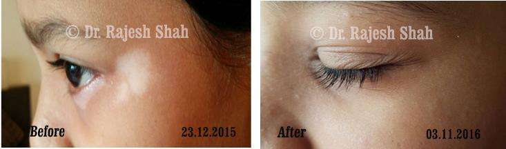 Vitiligo Before and After Case Photo