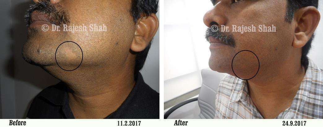 Alopecia Areata Before and After Case Photo