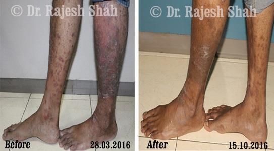 Psoriasis Before and After Case Photo