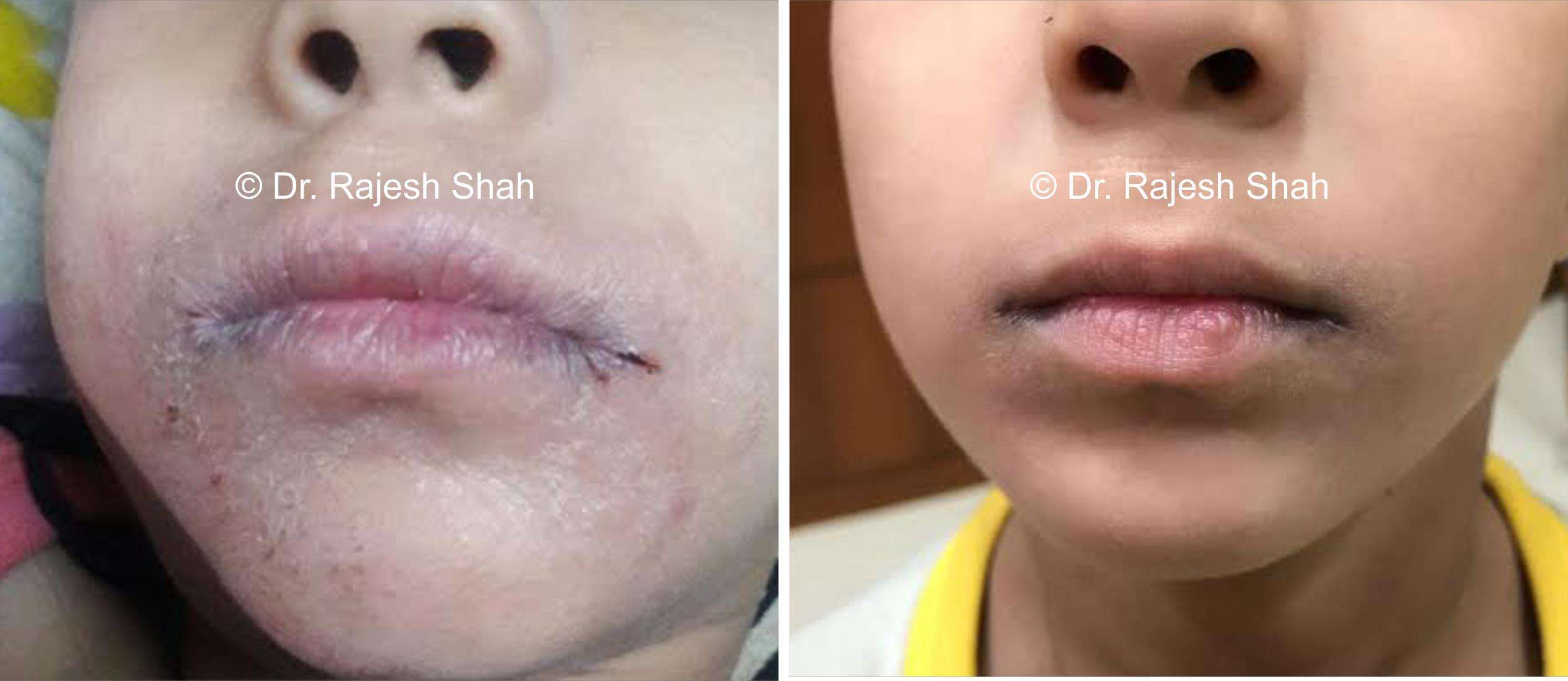 Eczema Before and After Case Photo