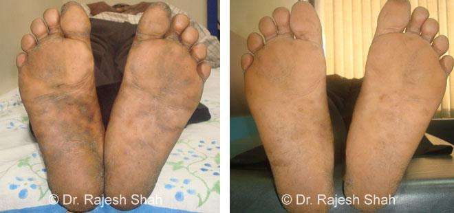 Psoriasis Before and After Case Photo