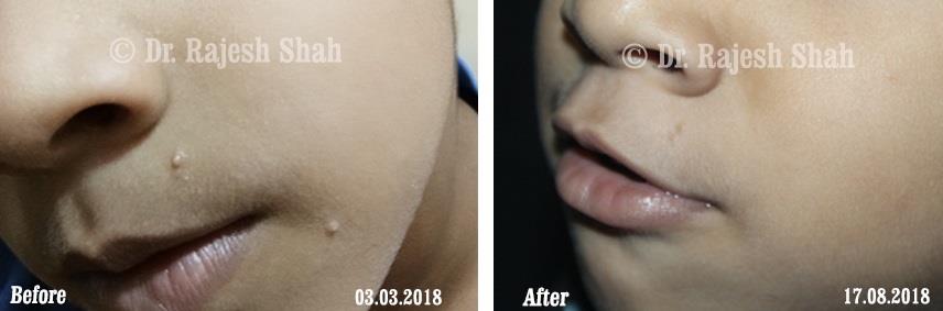 Molluscum contagiosum Before and After Case Photo