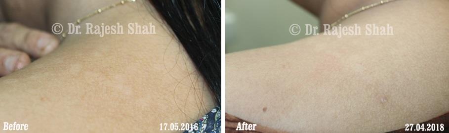 Pityriasis Versicolor Before and After Case Photo