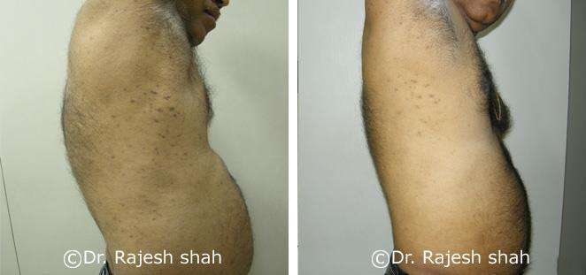 Psoriasis Before and After Case Photo