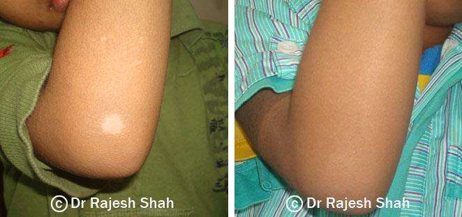 Vitiligo Before and After Case Photo