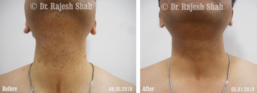 Lichen Planus Before and After Case Photo