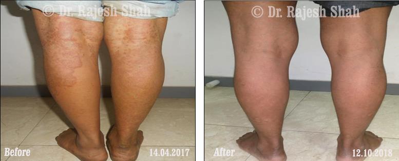 Psoriasis Before and After Case Photo