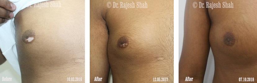 Vitiligo Before and After Case Photo