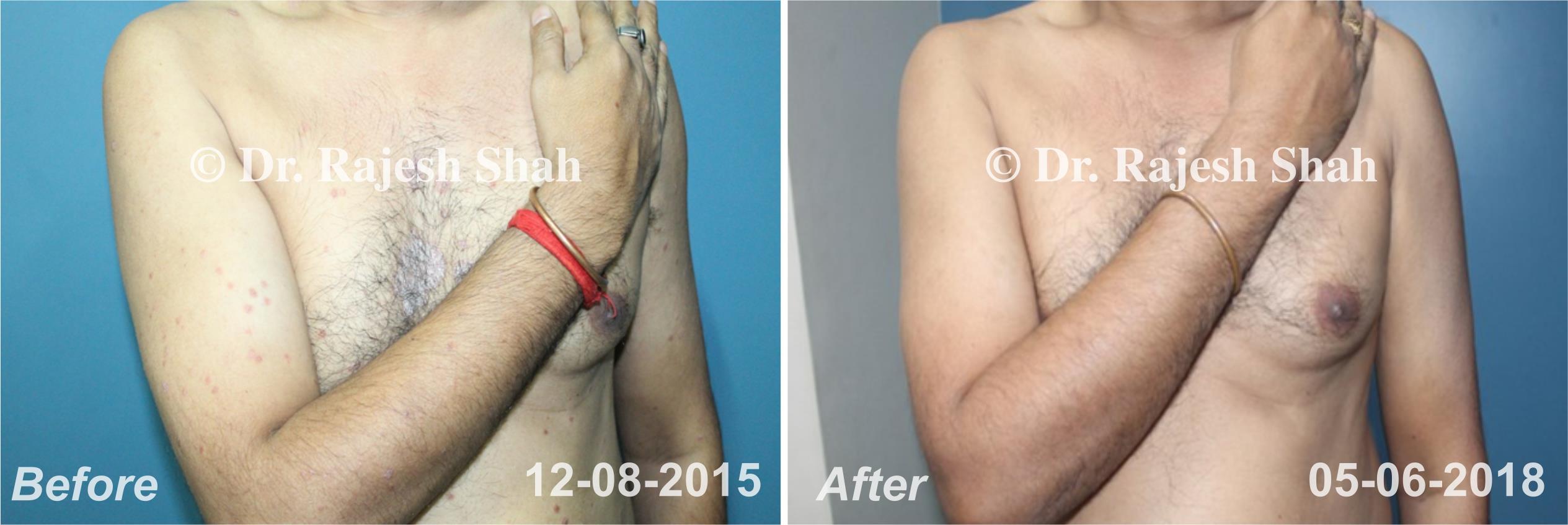 Psoriasis Before and After Case Photo