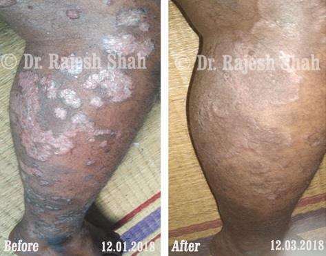 Psoriasis Before and After Case Photo