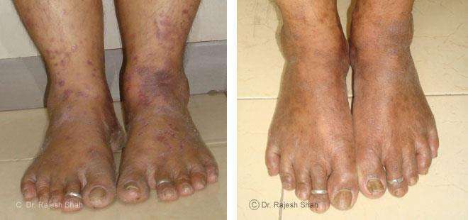 Lichen Planus Before and After Case Photo