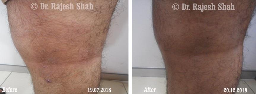 Atopic Dermatitis Before and After Case Photo