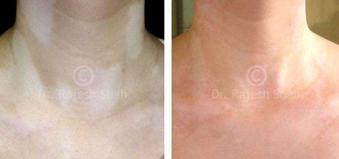 Vitiligo Before and After Case Photo