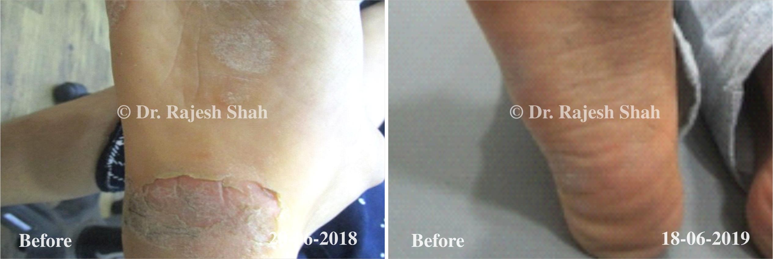 Eczema Before and After Case Photo