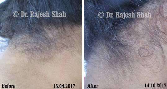 Psoriasis Before and After Case Photo