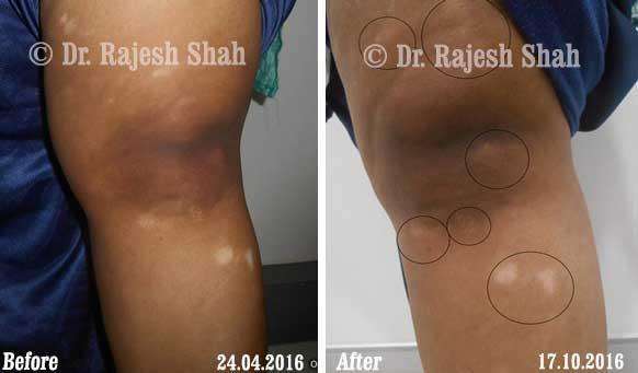 Vitiligo Before and After Case Photo