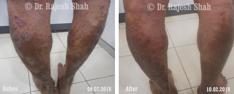 Psoriasis Before and After Case Photo