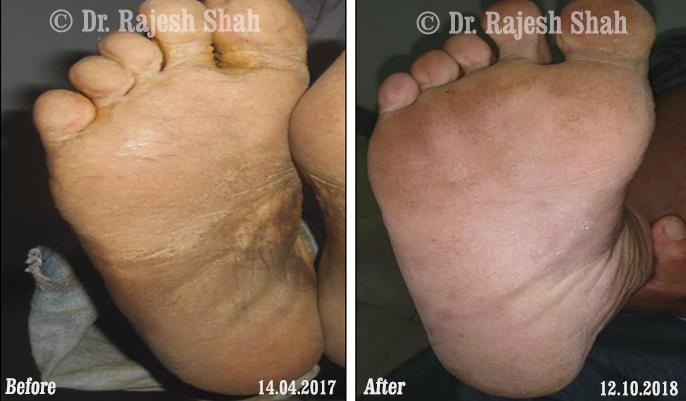 Psoriasis Before and After Case Photo