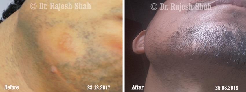 Alopecia Areata Before and After Case Photo