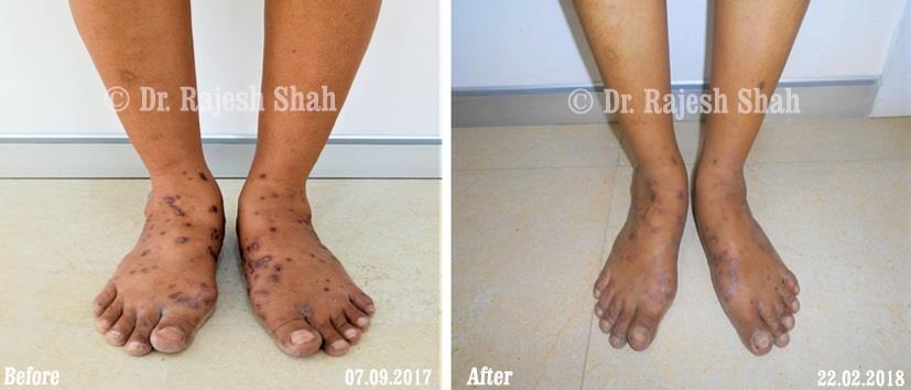 Lichen Planus Before and After Case Photo