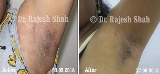 Pityriasis Rosea Before and After Case Photo