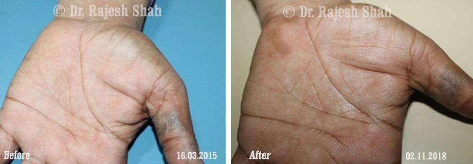 Psoriasis Before and After Case Photo