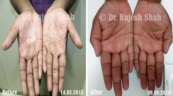 Psoriasis Before and After Case Photo