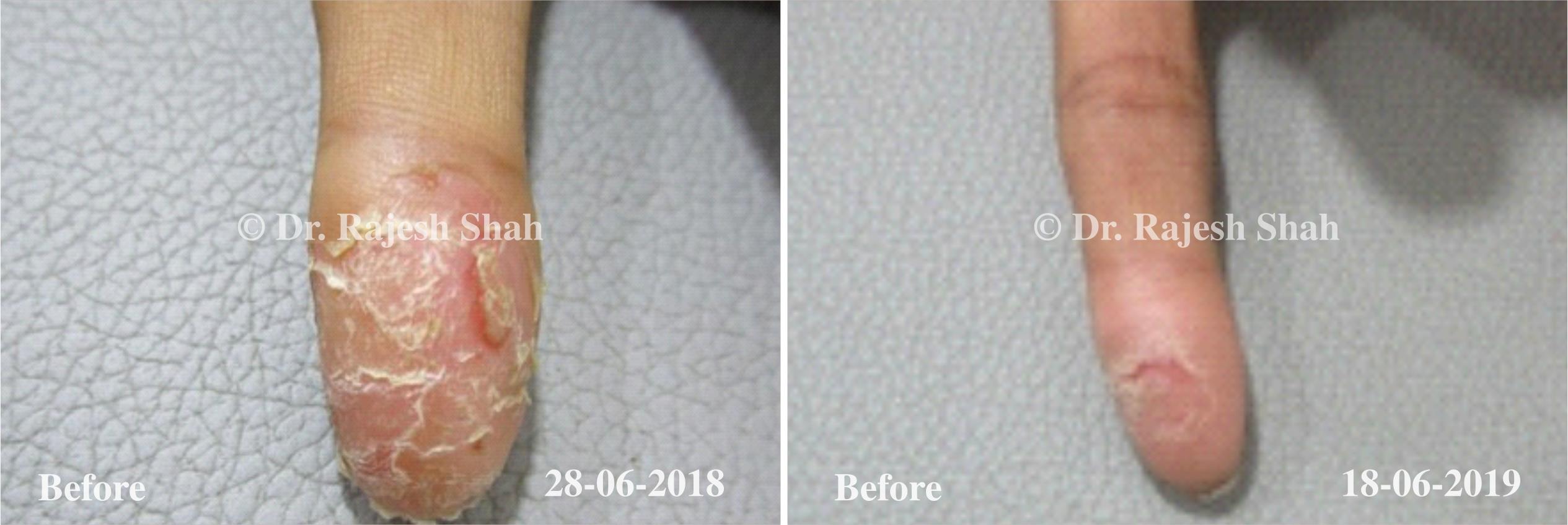 Eczema Before and After Case Photo