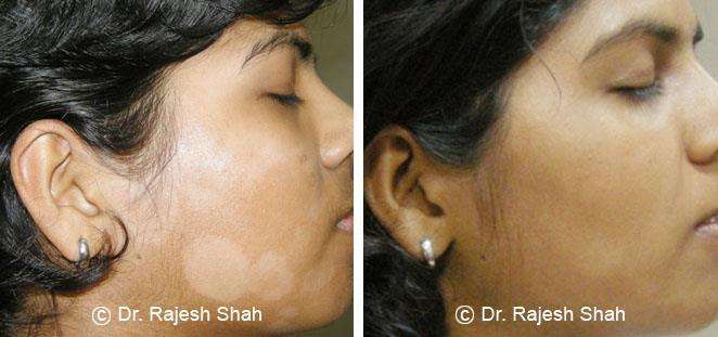 Psoriasis Before and After Case Photo