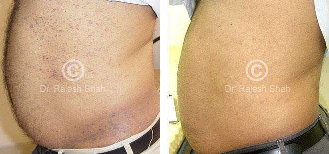 Lichen Planus Before and After Case Photo