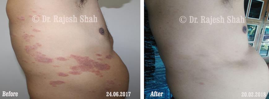 Psoriasis Before and After Case Photo