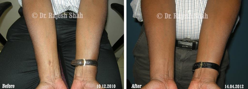 Lichen Planus Before and After Case Photo