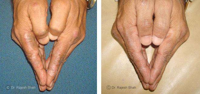 Psoriasis Before and After Case Photo