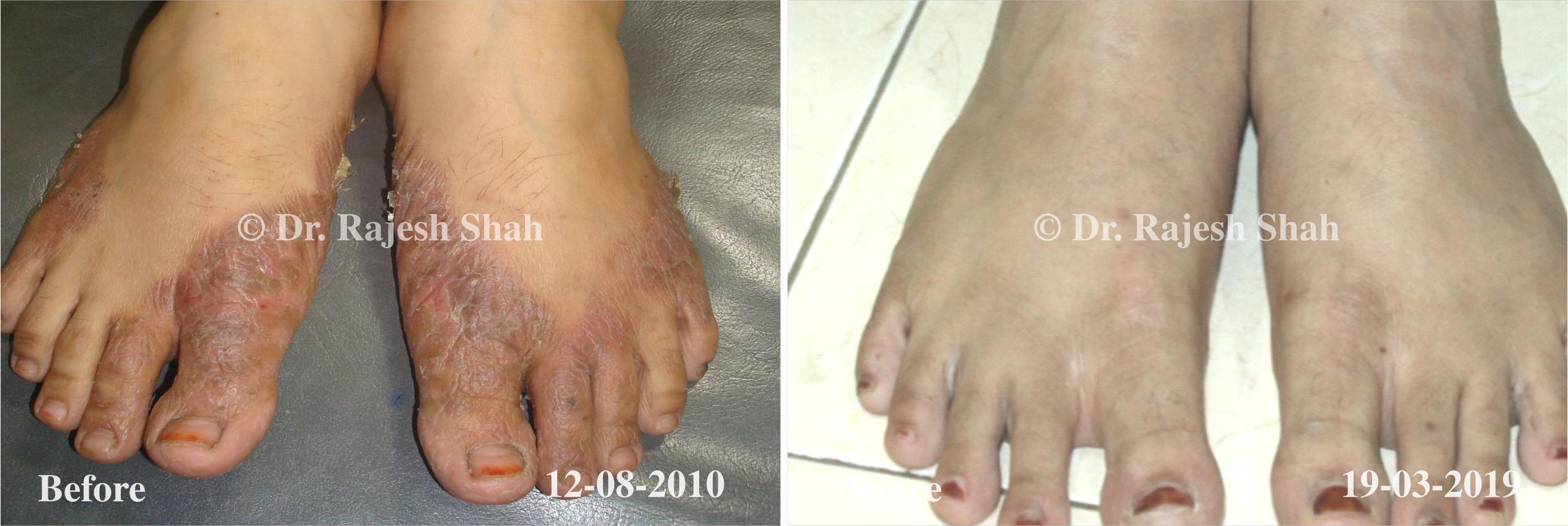 Psoriasis Before and After Case Photo