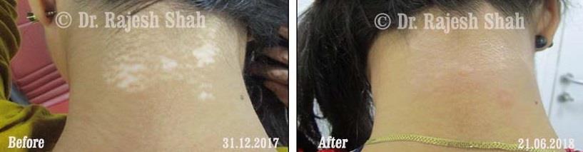 Vitiligo Before and After Case Photo