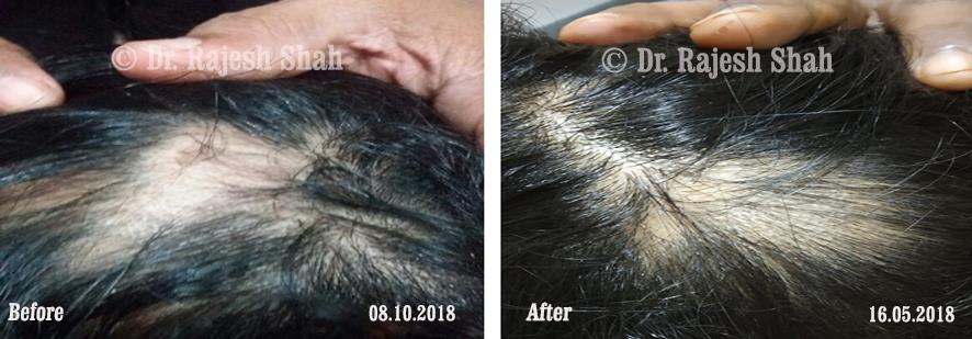 Alopecia Areata Before and After Case Photo
