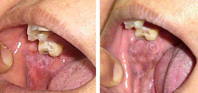 Lichen Planus Before and After Case Photo