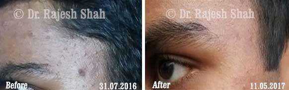 Acne Before and After Case Photo