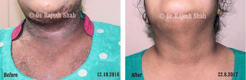 Psoriasis Before and After Case Photo