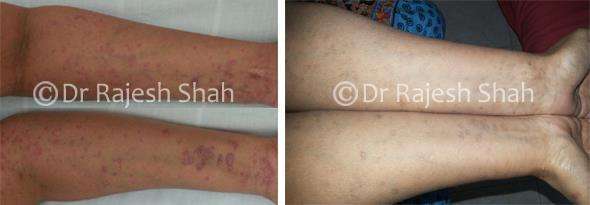 Lichen Planus Before and After Case Photo
