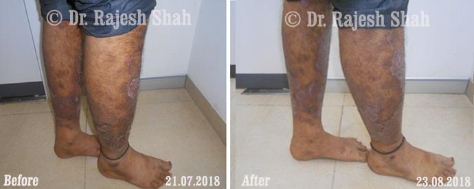 Psoriasis Before and After Case Photo
