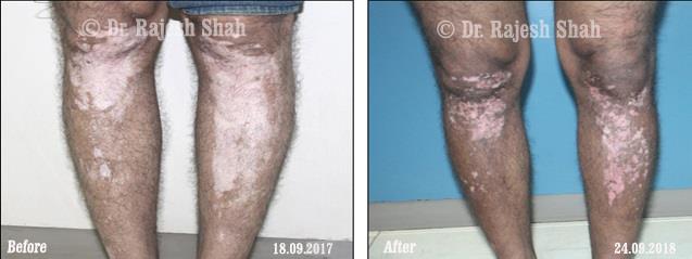 Vitiligo Before and After Case Photo