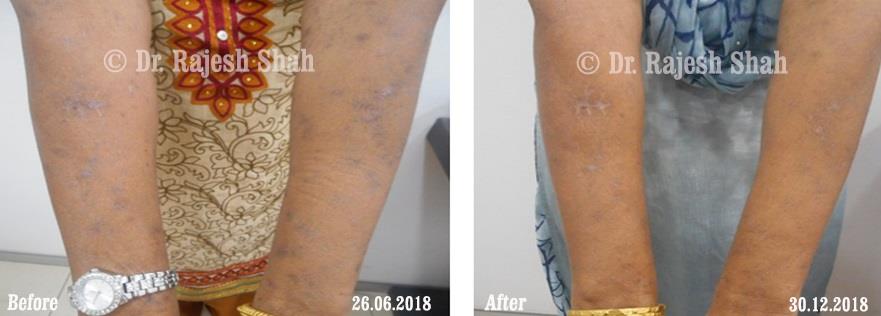 Lichen Planus Before and After Case Photo